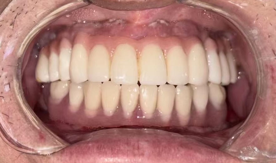 戴牙后照片